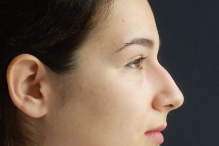 ترند عجیب ۲۰۲۶: طغیان «بینی قوزدار» علیه استانداردهای زیبایی